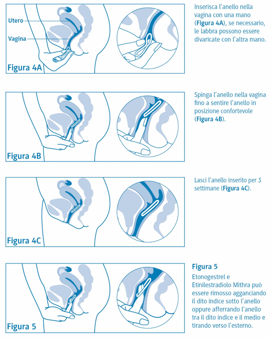 Effetti collaterali clearance anello vaginale